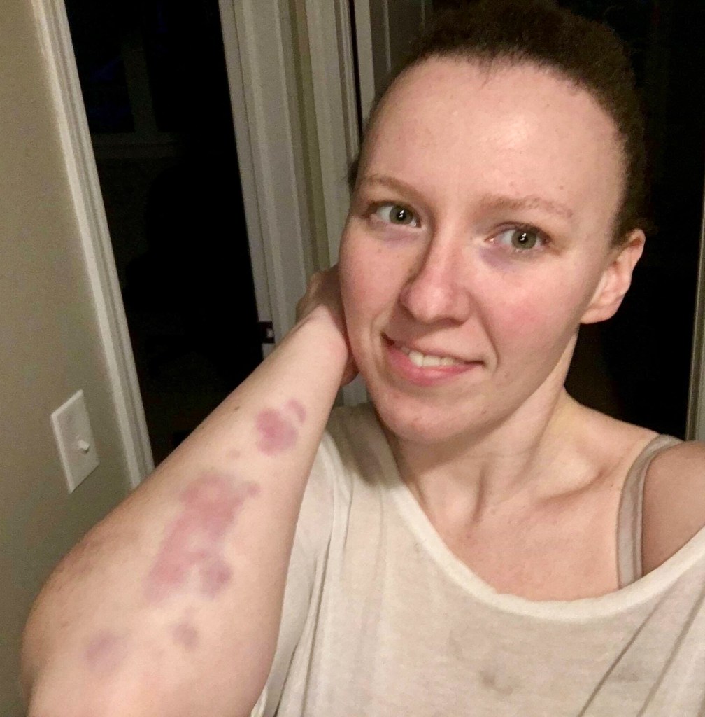 Martial arts and bruising